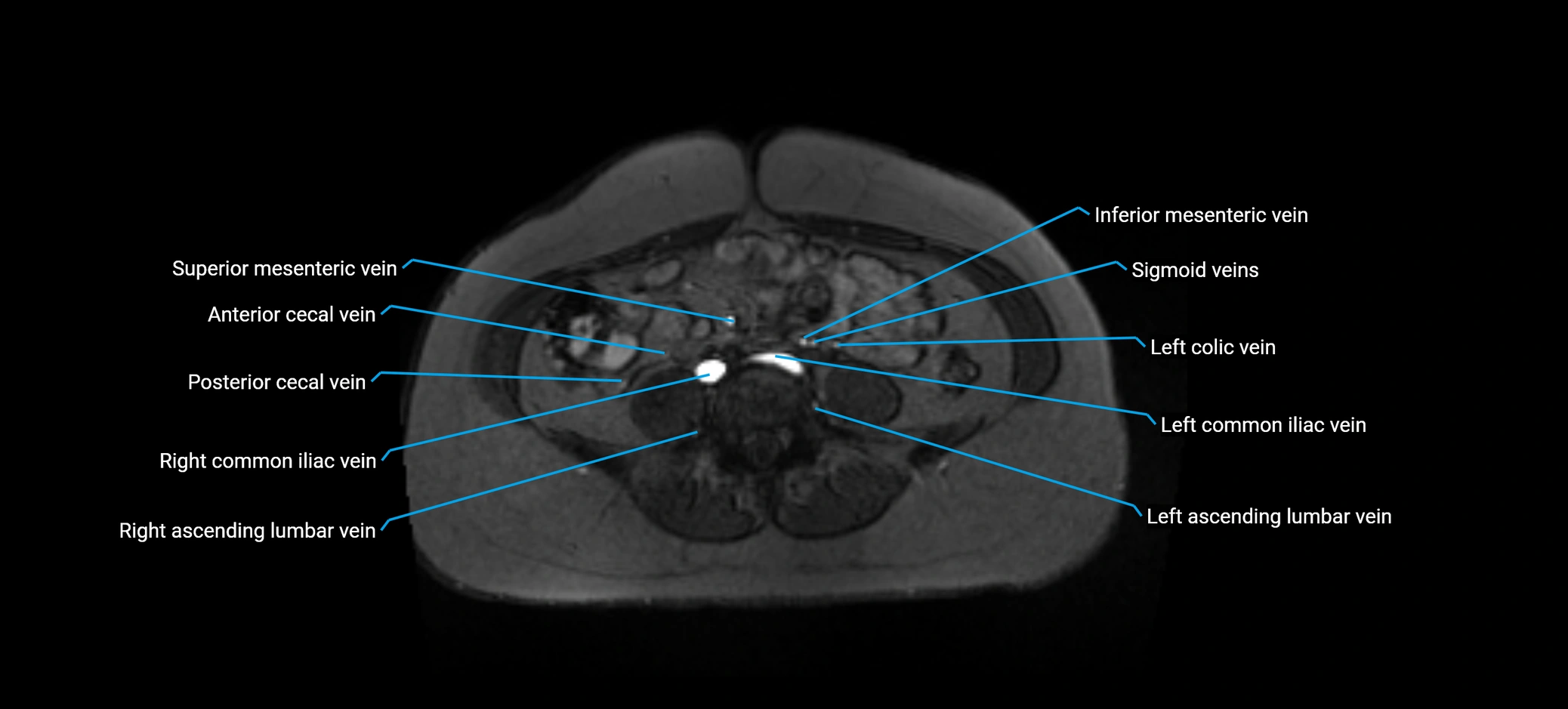 MRV abdomen pelvis & lower limb axial cross sectional anatomy labelled MRI image 119 (1).webp